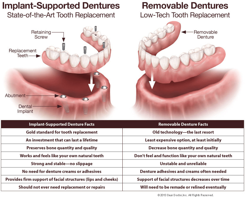 Denture Comparison
